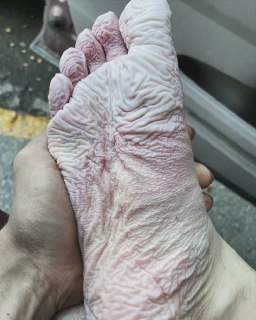 Обморожение и траншейная стопа: как отличить и правильно оказать помощь