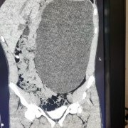 Подросток из Новосибирска спасен от разрыва почки благодаря медосмотру