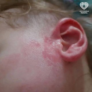 Столичные хирурги спасли ухо ребенка после ожога III степени