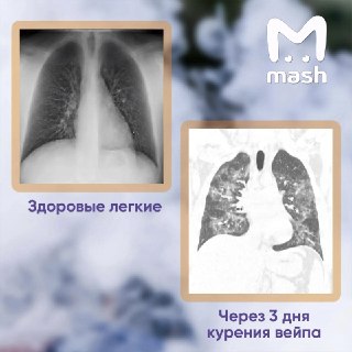 У 19-летнего любителя вейпов в Саратовской области отказали легкие