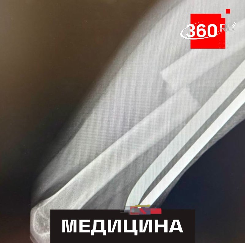 Поездка вдвоем на электросамокате закончилась для девочки переломом бедра
