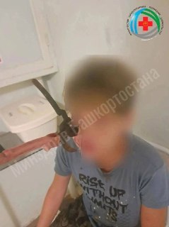 Башкирские врачи спасли подростка от слепоты после травмы секатором