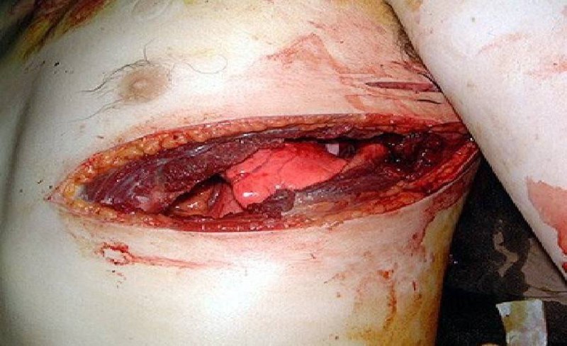 Скорость развития напряженного пневмоторакса в зависимости от размера входного отверстия раны